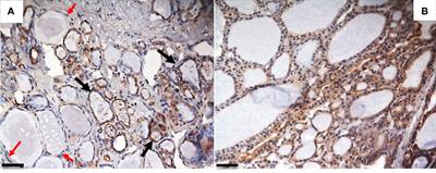 The crossroad between autoimmune disorder, tissue remodeling and cancer of the thyroid: The long pentraxin 3 (PTX3)